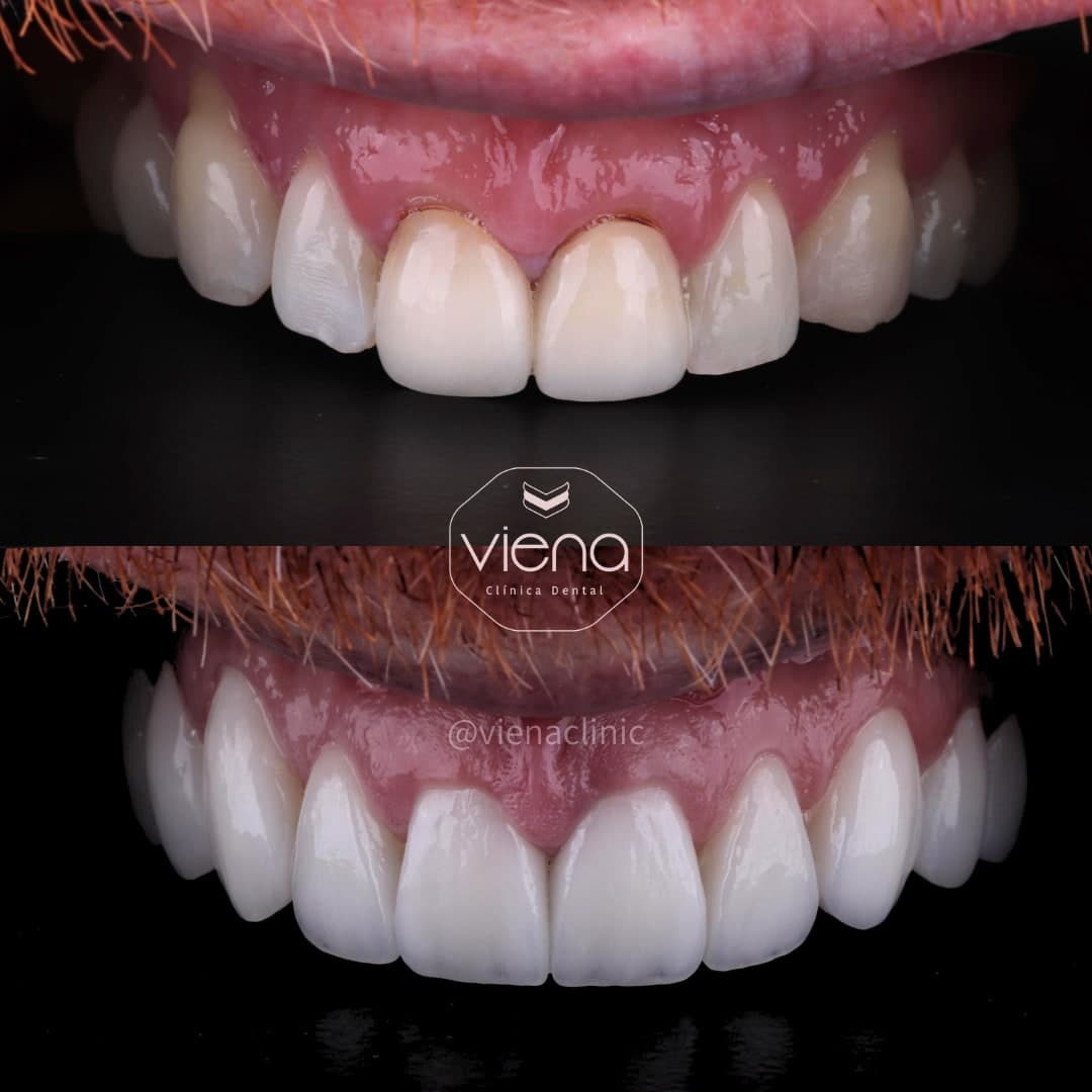 Clínica Viena / Veneers Medellín